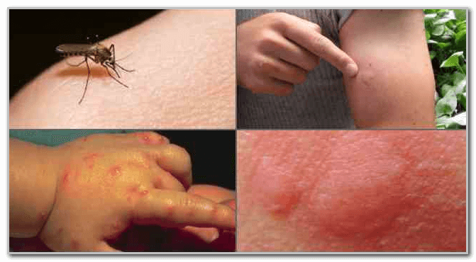 Аптечные средства и народные методы, используемые после укусов комаров